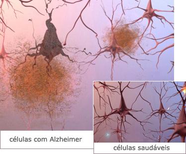 Neurônios de paciente com Alzheimer